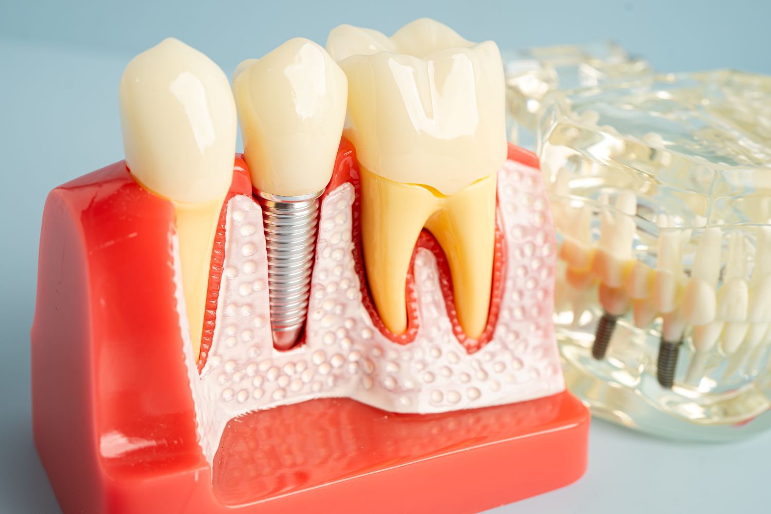 Çene kemiği erimesinde implant yapılabilir mi?