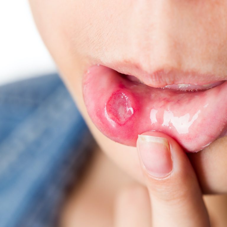 Ağız İçi Yumuşak Doku Değişimleri: Lökoplaki, Liken Planus ve Erken Dönem Oral Patoloji Teşhisinde Rutin Muayenenin Hayati Rolü
