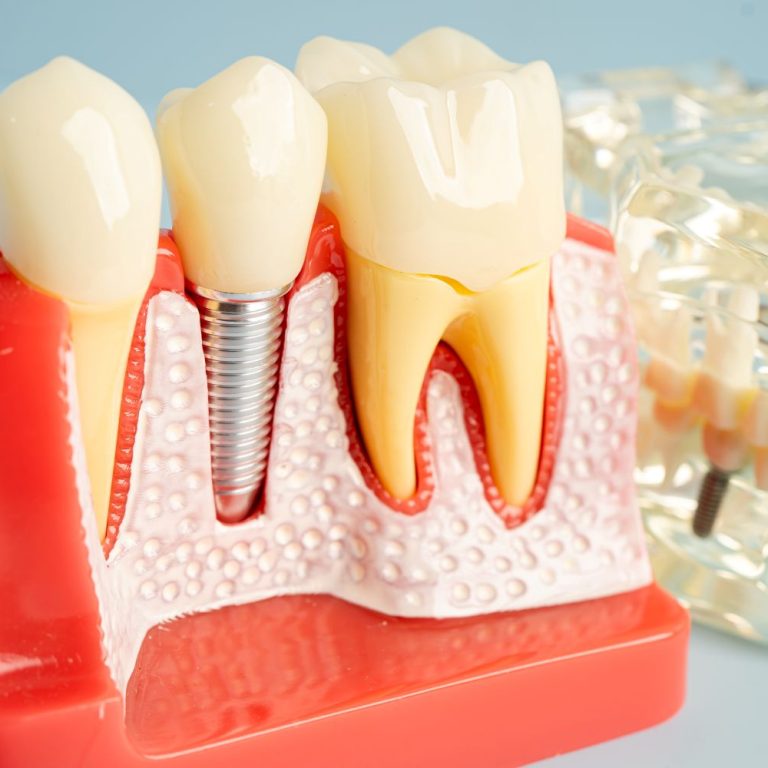 Çene kemiği erimesinde implant yapılabilir mi?