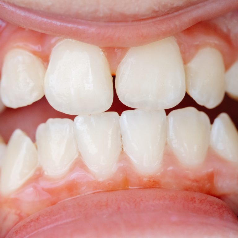Young woman sitting in a dental chair, experiencing discomfort from tooth pain while waiting for treatment in a clinic