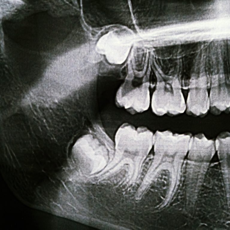 Panoramic X-ray of the jaw. X-ray of the teeth of a 12-year-old girl.