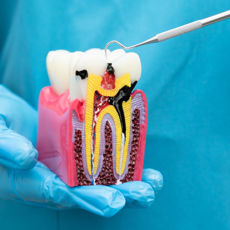 dentist holding dental implant, artificial tooth roots into jaw, root canal of dental treatment, gum disease, teeth model for dentist.