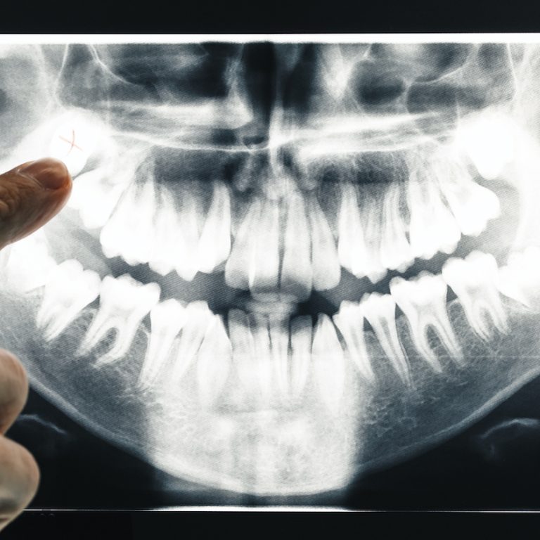 Dentist tools on Blue Background with copy space