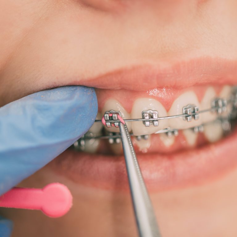 Dentist checking bracket at the braces on the female patient. Close-up. Real People.