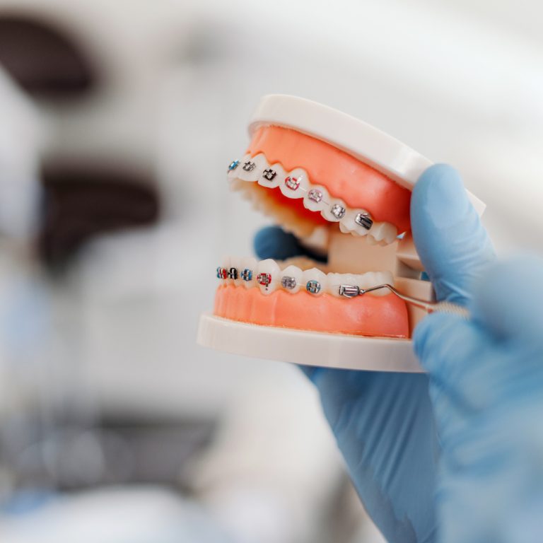 Closeup, dentist holding jaw with braces in his hand. Orthodontic treatment, dental care concept