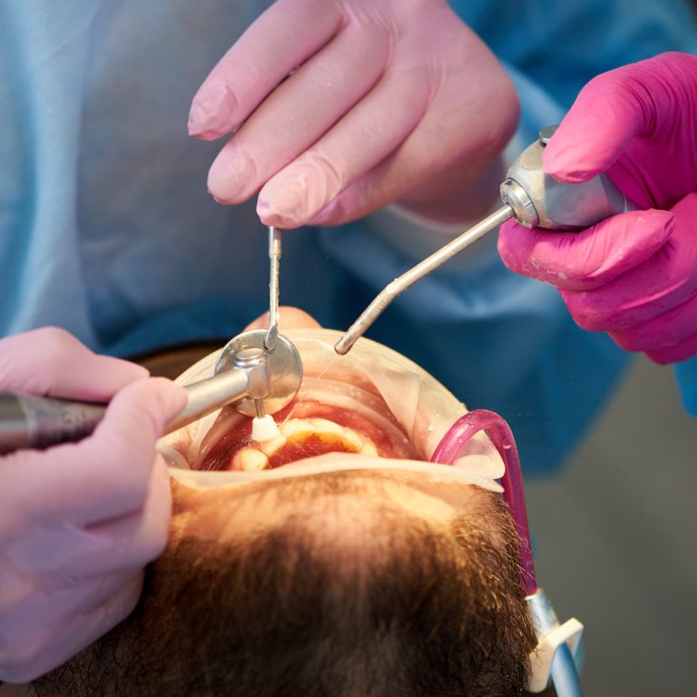 Closeup of a scaling and polishing procedure performed by two dentists in pink gloves to a male client.