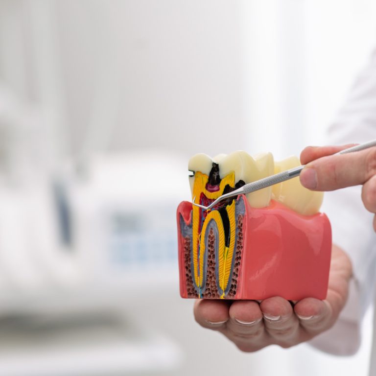 Dentist displays a tooth model to highlight its anatomy and the importance of dental care during a consultation. Caries treatment