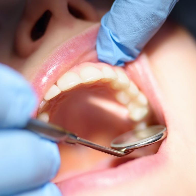Dentist treats young woman teeth in hospital. Doctor Practitioner examines the patient before orthodontists or prosthetics treatment at modern medical center. Close up view of teeth and hands. Banner
