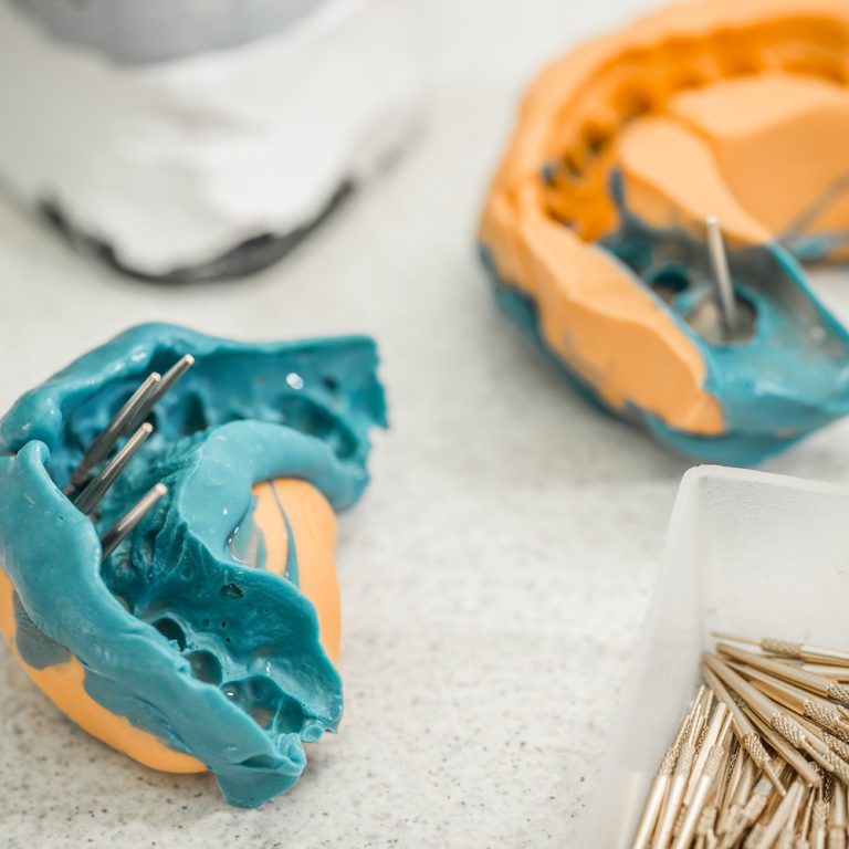 Dental impression and tooth model, denture concept