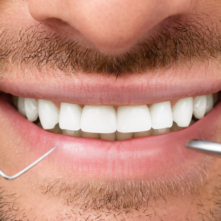 Ankara diş kliniği tecrübemizle, Çankaya Gaziosmanpaşa lokasyonunda implant başarınızı kalıcı hale getiriyoruz. Bu rehberle, implant sonrası iyileşme aşamalarını bir bekleme süresinden ziyade, dişinizin kemikle tam kaynaştığı sağlıklı bir sürece dönüştürün.