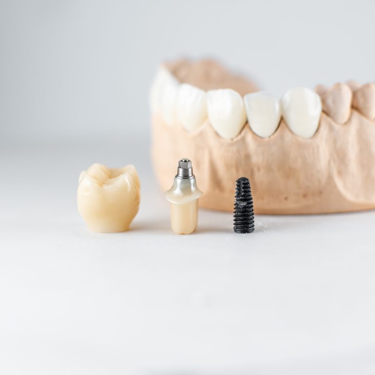 Close-up on plaster model of artificial jaw and dental implant on the white background. Concept of prosthetics and implantation in dentistry