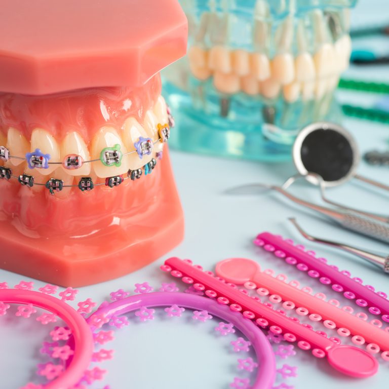 Orthodontic ligatures rings and ties, elastic rubber bands on orthodontic braces, model for dentist studying about dentistry.